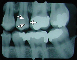 x-ray with cavity